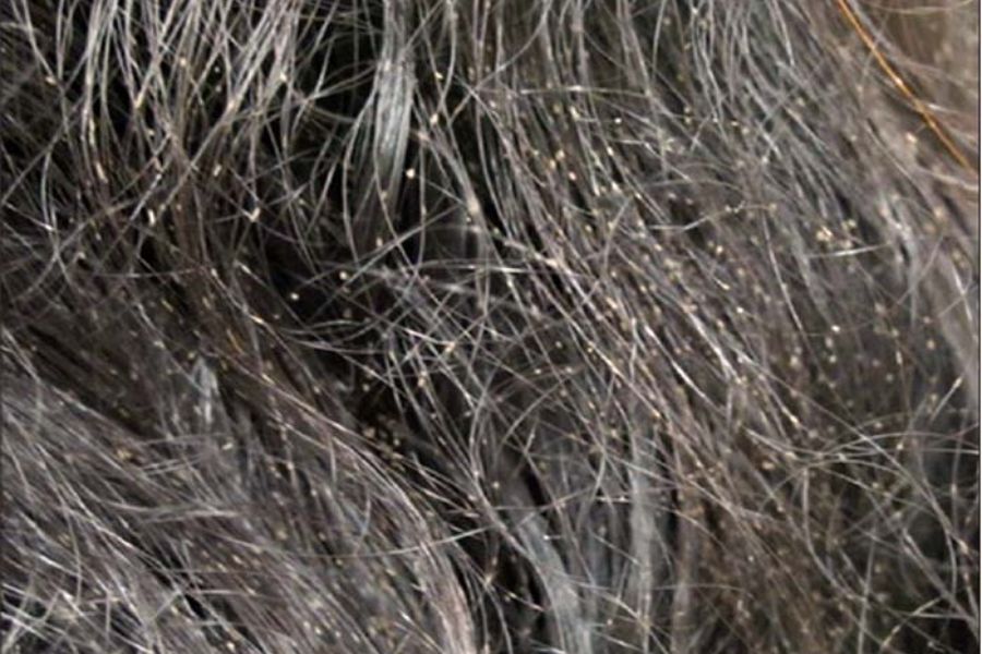caruncho no cabelo