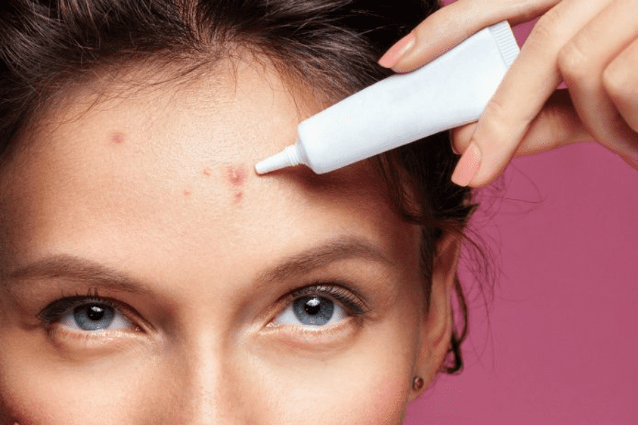 melhor gel secativo para espinhas