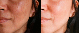 Rosa Mosqueta Antes e Depois Rosa Mosqueta Antes e Depois
